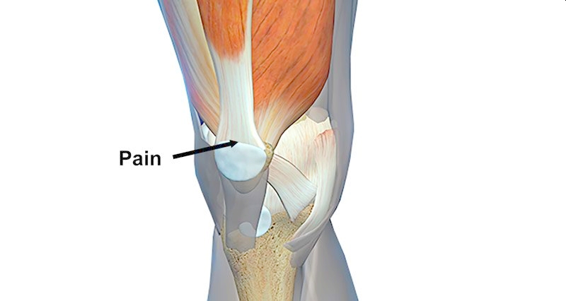 Dr Emmy's Blog Article on Tendinopathies